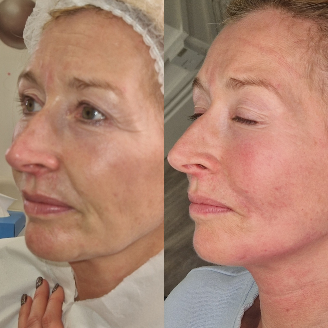 Anti-wrinkle & Lower Face Rejuvenation