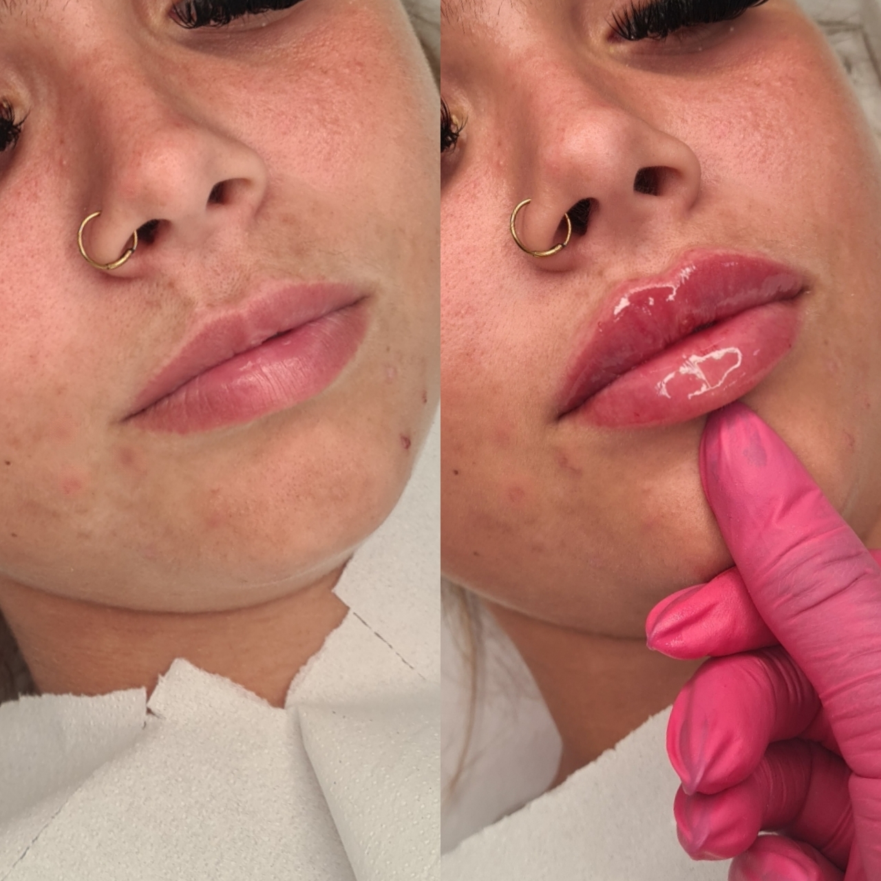 Lip Enhancement
