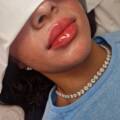 Introducing our new technique for lip enhancement